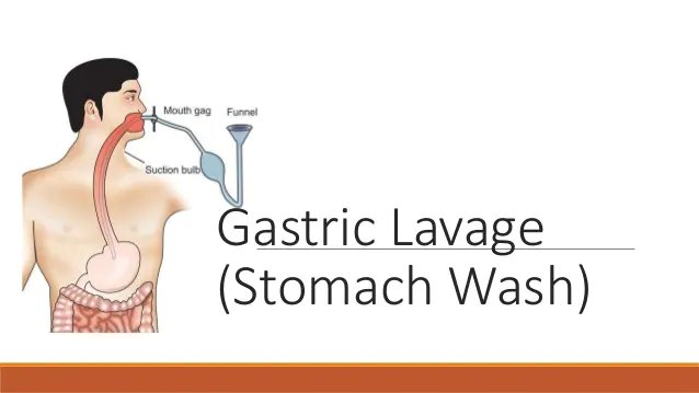 Gastric-Lavage-image