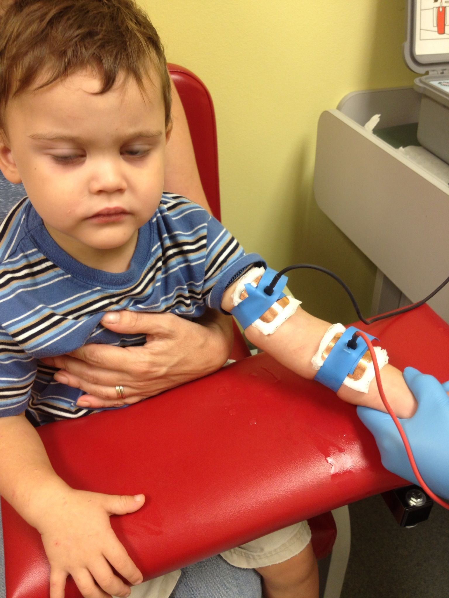 Sweat Chloride Test in child